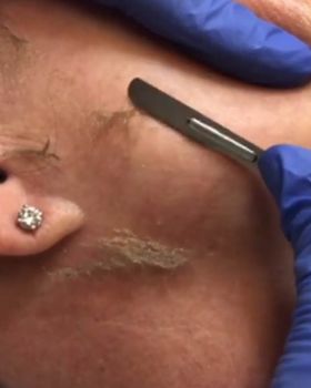 Dermaplaning